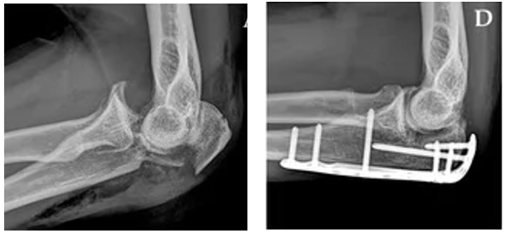 Understanding Elbow Dislocations with Orthopaedic Specialist, Dr Gandhi